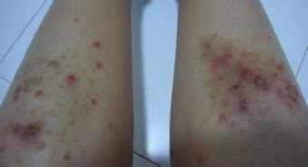 长沙肤康专家带领你了解湿疹