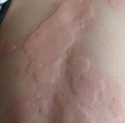 急性荨麻疹 你知多少