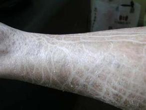荨麻疹患者需了解的事项