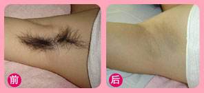 治疗腋臭有哪些方法