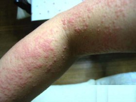治疗湿疹的几种方法