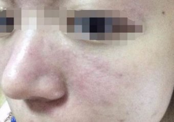治疗酒糟鼻应该注意什么