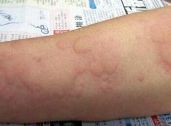 当荨麻疹发作的时候怎么办