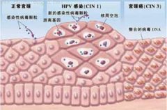 引发尖锐湿疣主要原因有哪些
