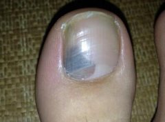 去除灰指甲有哪些方法