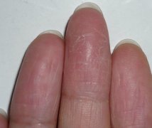   关于皮炎的护理方式都有哪些