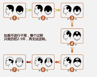油性发质的人们应该注意哪些