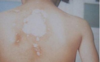 白癜风患者需要规避哪些误区